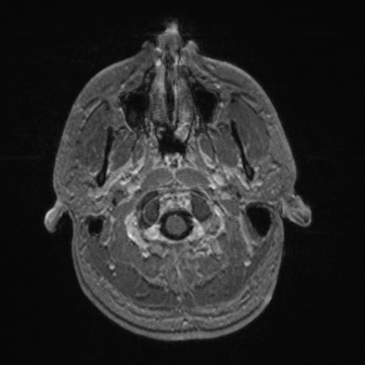 File:Colloid cyst (Radiopaedia 44510-48181 Axial T1 C+ 24).png
