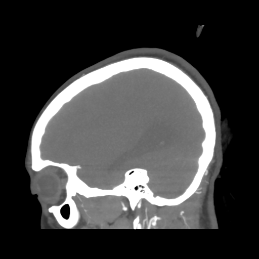 File:Colloid cyst (resulting in death) (Radiopaedia 33423-34499 B 14).png