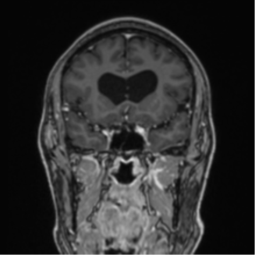 File:Colloid cyst of the third ventricle (Radiopaedia 86571-102662 Coronal T1 C+ 62).png