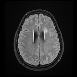 File:Colloid cyst with anterior communicating artery aneurysm (Radiopaedia 33901-35091 Axial FLAIR 17).jpg