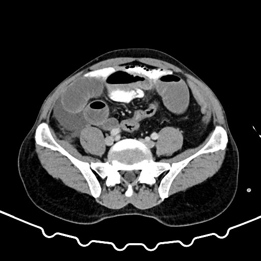 Colocolic intussusception due to large lipoma (Radiopaedia 68773-78482 A 134).jpg