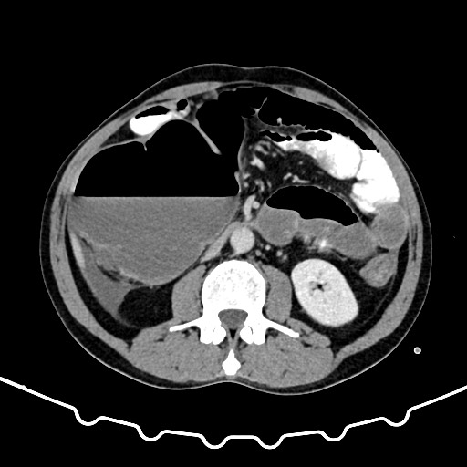 File:Colocolic intussusception due to large lipoma (Radiopaedia 68773-78482 A 88).jpg