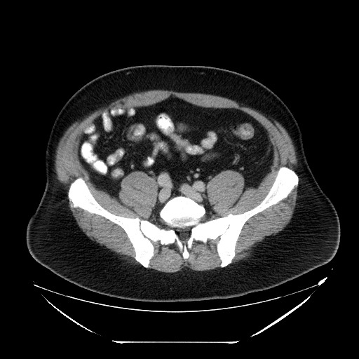 File:Colocolic intussusception due to lipoma (Radiopaedia 73712-84508 Axial 84).jpg
