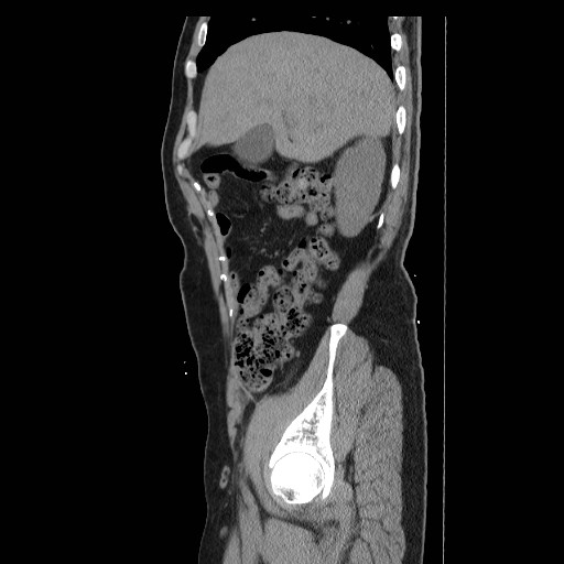 File:Colocutaneous fistula in Crohn's disease (Radiopaedia 29586-30093 C 2).jpg