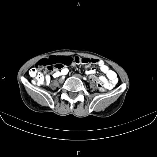 Colon adenocarcinoma - hepatic flexure (Radiopaedia 85635-101395 A 62).jpg