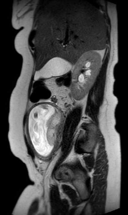 Colon adenocarcinoma with Krukenberg tumors, advanced pregnancy (Radiopaedia 67279-76645 Sagittal T2 36).jpg