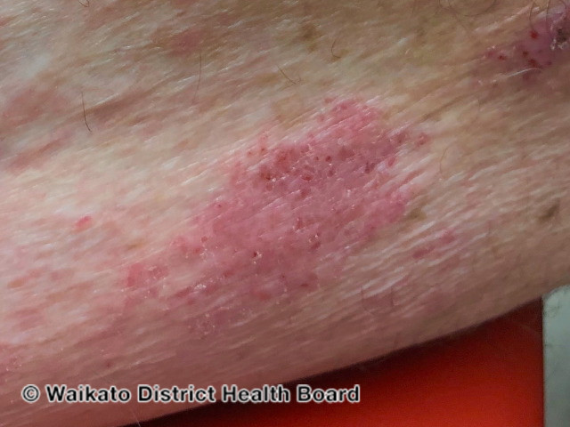 File:Dermatitis induced by pembrolizumab (DermNet NZ pembrolizumab-eczema-06).jpg