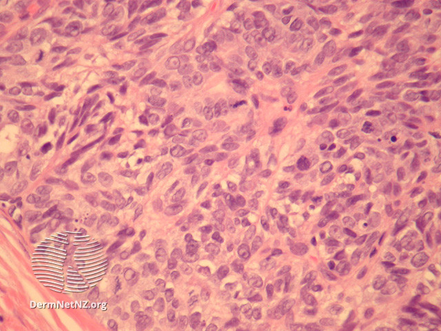 File:Figure 6 (DermNet NZ pathology-e-aggressive-adenocarcinoma-fig6).jpg