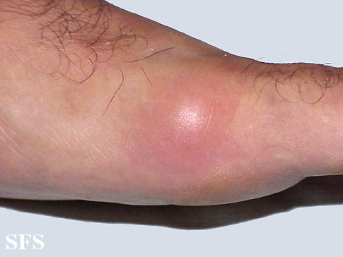 File:Gout (Dermatology Atlas 2).jpg