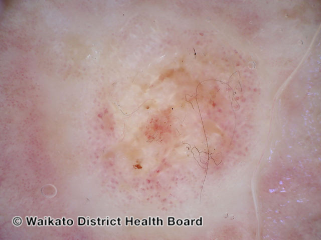 File:Intraepidermal carcinoma, polarised dermoscopy view (DermNet NZ 150828-v2).jpg