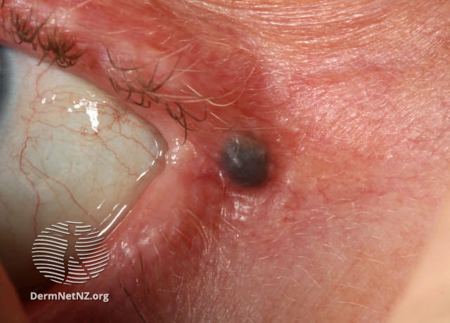 File:More images of hidrocystoma of the eyelid. (DermNet NZ hidrocystoma-03).jpg