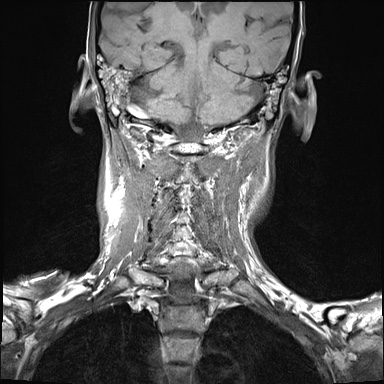 File:Nasopharyngeal carcinoma with skull base invasion (Radiopaedia 59258-66600 Coronal T1 6).jpg