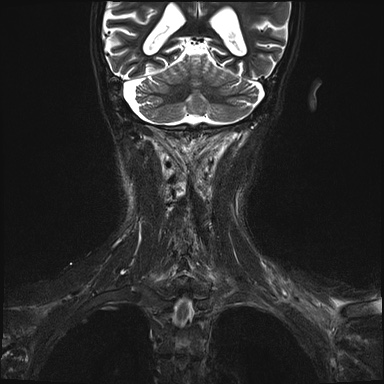 Nasopharyngeal carcinoma with skull base invasion (Radiopaedia 59258-66600 Coronal T2 fat sat 1).jpg