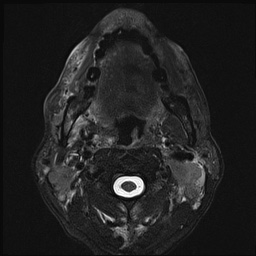 File:Nasopharyngeal carcinoma with skull base invasion (Radiopaedia 59258-66600 D 33).jpg