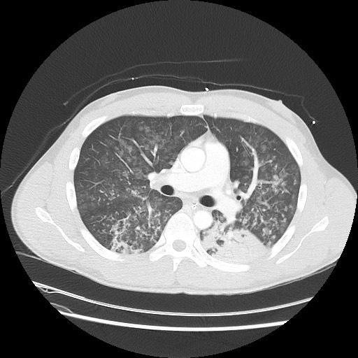 Near-drowning pulmonary edema (Radiopaedia 59457-66814 Axial lung window 26).jpg