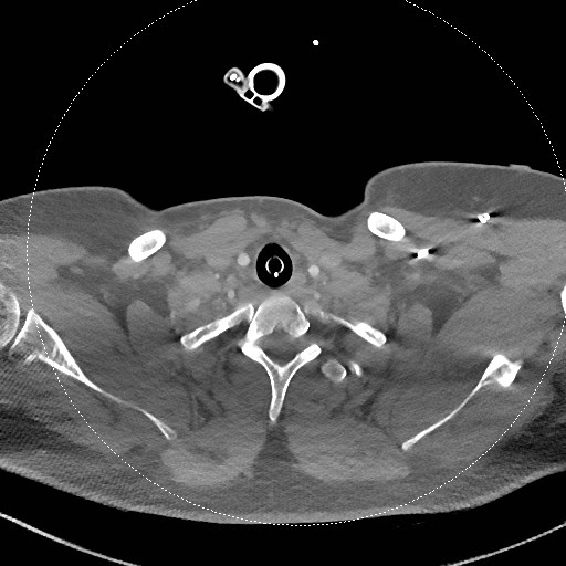 Neck CT angiogram (intraosseous vascular access) (Radiopaedia 55481-61945 B 111).jpg