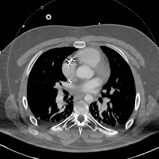 Neck CT angiogram (intraosseous vascular access) (Radiopaedia 55481-61945 B 8).jpg