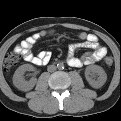 File:Necrotizing pancreatitis with acute necrotic collection (Radiopaedia 14470-14417 Axial non-contrast 26).jpg
