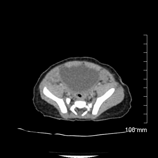 File:Neonatal neuroblastoma (Radiopaedia 56651-63438 Axial non-contrast 65).jpg