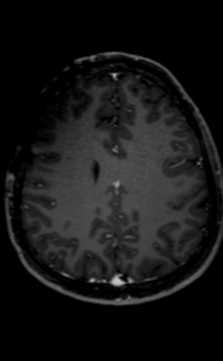 Neuro-Behçet disease (Radiopaedia 90112-107294 Axial T1 C+ 97).jpg