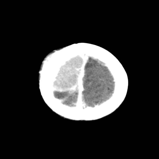 File:Neuroblastoma (Radiopaedia 8176-36438 Axial C+ delayed 5).jpg