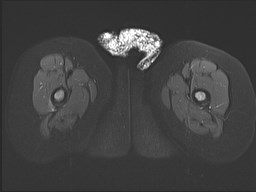 File:Neuroblastoma with bone metastases (Radiopaedia 67080-76414 Axial STIR 35).jpg