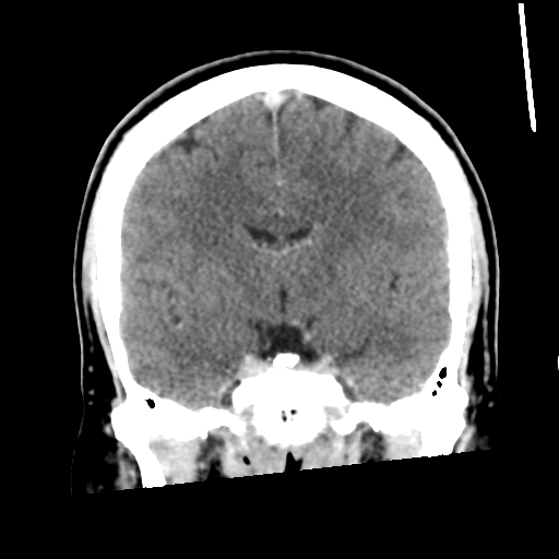 Neurocysticercosis - granular nodular (Radiopaedia 42786-45957 Coronal C+ 32).png