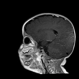 File:Neurofibromatosis type 1 (Radiopaedia 30089-30671 Sagittal T1 C+ 5).jpg