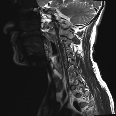 File:Neurofibromatosis type 1 (Radiopaedia 80355-93740 Sagittal T2 9).jpg
