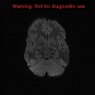 File:Neurofibromatosis type 1 with optic nerve glioma (Radiopaedia 16288-15965 Axial DWI 62).jpg