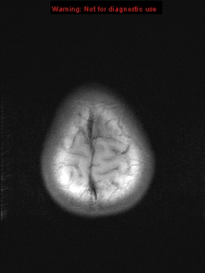 File:Neurofibromatosis type 1 with optic nerve glioma (Radiopaedia 16288-15965 Axial T1 2).jpg