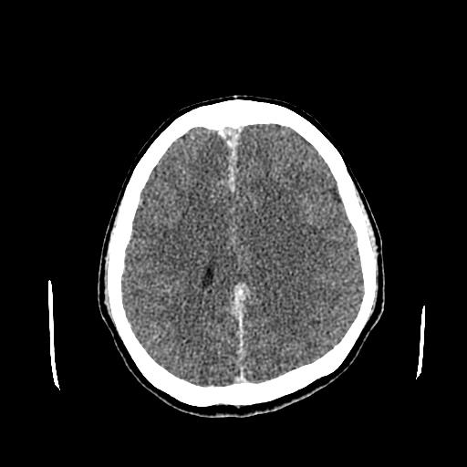 File:Neurofibromatosis type 2 (Radiopaedia 25389-25637 Axial C+ 63).jpg