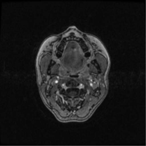 Neurofibromatosis type 2 (Radiopaedia 45229-49244 Axial T1 C+ 6).png