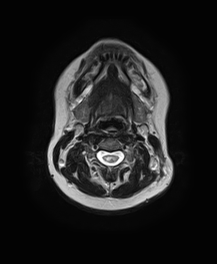 File:Neurofibromatosis type 2 (Radiopaedia 66211-75401 Axial T2 1).jpg