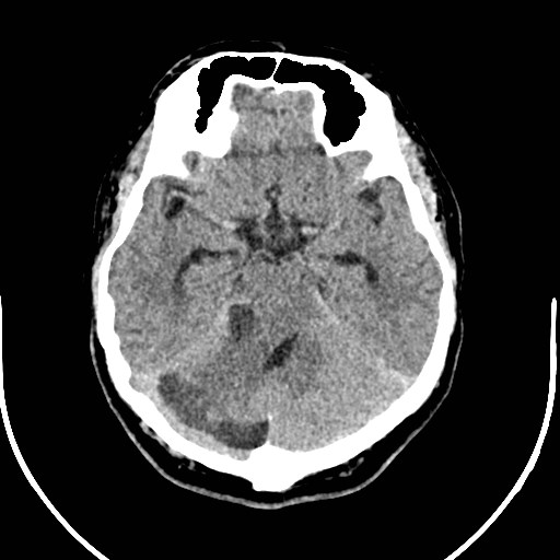 Neurofibromatosis type 2 (Radiopaedia 79097-92047 Axial non-contrast 21).jpg