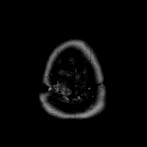 File:Neurofibromatosis type 2 (Radiopaedia 8713-9518 Axial T2 1).jpg