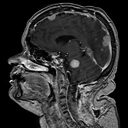 File:Neurofibromatosis type 2 (Radiopaedia 8713-9518 Sagittal T1 C+ 28).jpg