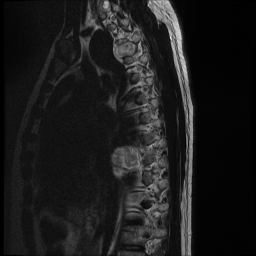 File:Neurofibromatosis type 2 (spinal manifestations) (Radiopaedia 53943-60070 C 12).png