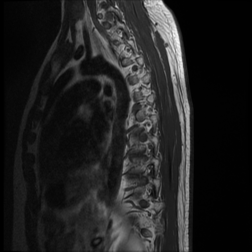 File:Neurofibromatosis type 2 (spinal manifestations) (Radiopaedia 53943-60070 D 3).png