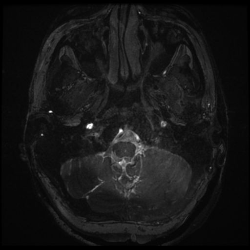 Neurofibromatosis type 2 - bilateral acoustic neuromata (Radiopaedia 40060-42566 Axial FIESTA 6).png