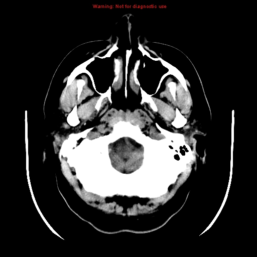 File:Neuroglial cyst (Radiopaedia 10713-11185 Axial non-contrast 29).jpg