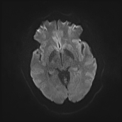 File:Neurotoxoplasmosis - concentric target sign (Radiopaedia 70644-80784 Axial DWI 10).jpg