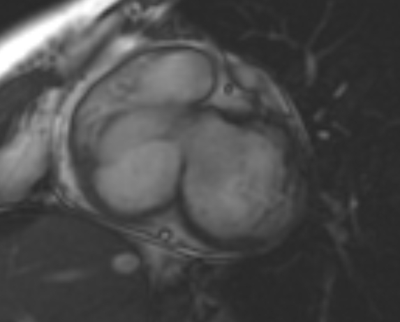 File:Non-compaction of the left ventricle (Radiopaedia 69436-79314 Short axis cine 199).jpg