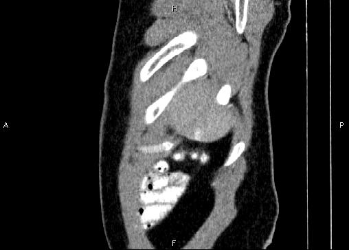 Non-syndromic pancreatic endocrine tumor (Radiopaedia 86958-103178 E 5).jpg