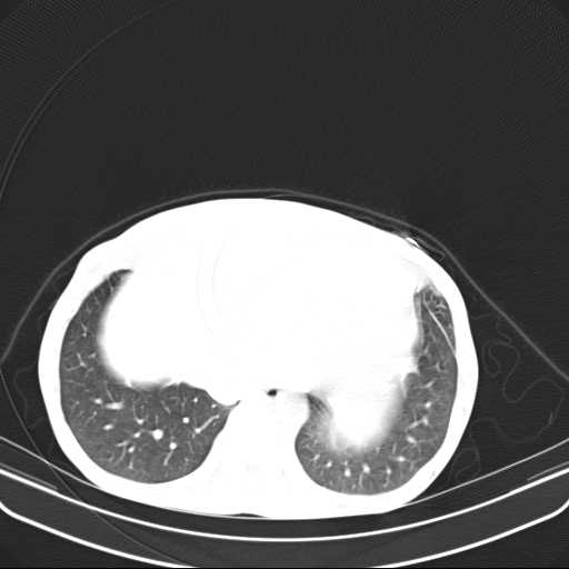 File:Non hodgkin lymphoma of the mediastinum (Radiopaedia 20814-20729 Axial lung window 44).jpg