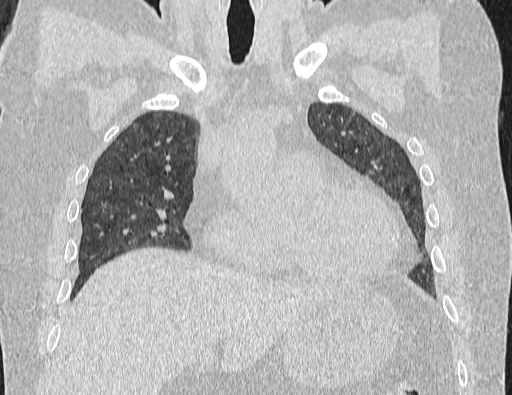 Non specific interstitial pneumonia (NSIP) (Radiopaedia 89725-106798 Coronal lung window 29).jpg