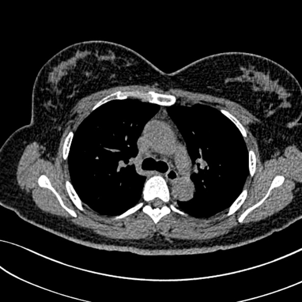 Normal CT chest- adult female (Radiopaedia 52522-58428 Axial non-contrast 49).jpg