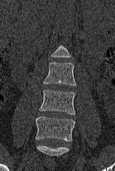 Normal CT lumbar spine (Radiopaedia 53981-60118 Coronal bone window 16).jpg