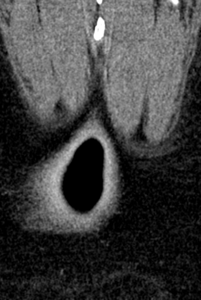 Normal CT lumbar spine (Radiopaedia 53981-60118 F 108).jpg