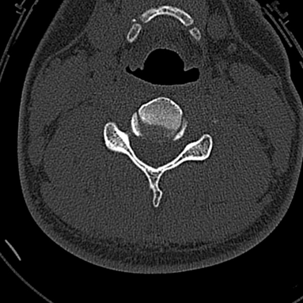 File:Normal CT of the cervical spine (Radiopaedia 53322-59305 Axial bone window 145).jpg